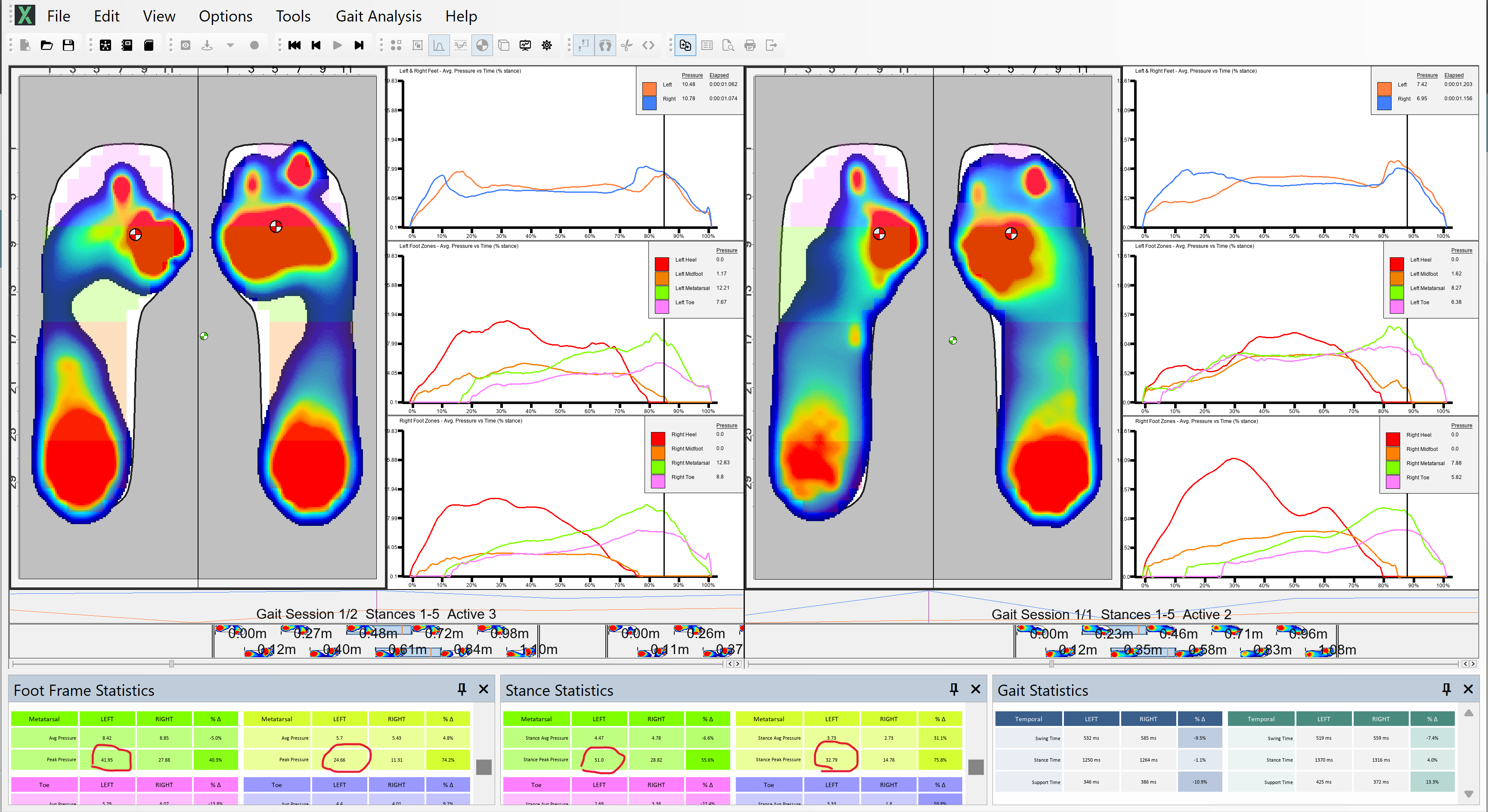 How XSENSOR's Insoles Influence My Intervention & Treatment of Foot